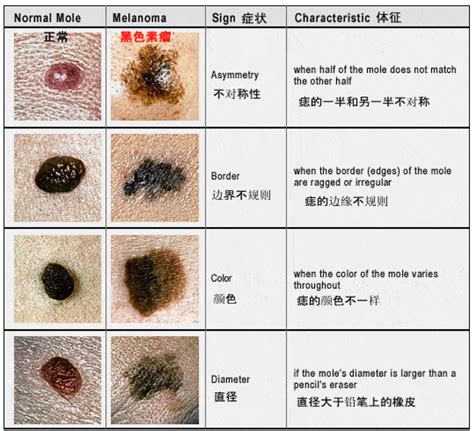 痣上长毛|痣也可能会癌变！长在 3 个地方要注意